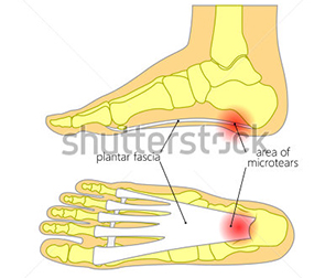 planterfaciitis - PodMarlow
